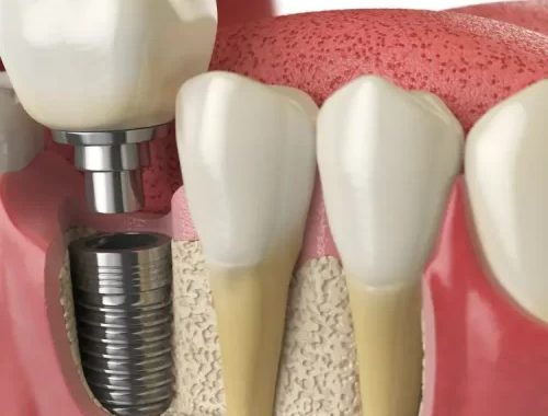 Your Guide To Metal Braces: Everything You Need To Know